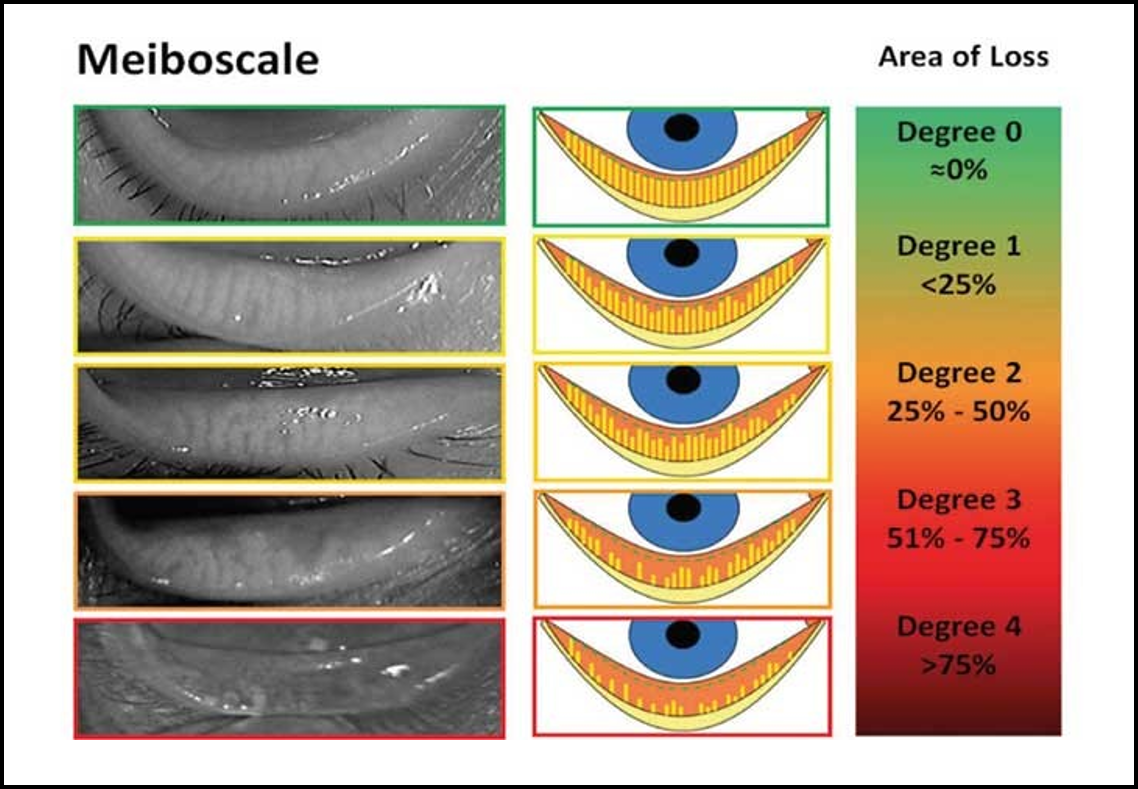 The Meiboscale used to measure the degree of meibomiam gland dysfunction